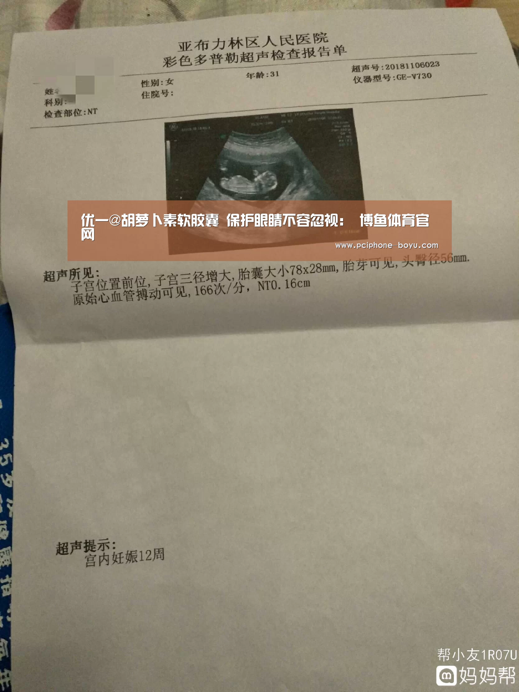 优一@胡萝卜素软胶囊 保护眼睛不容忽视: 博鱼体育官网(图3) 博鱼体育官网